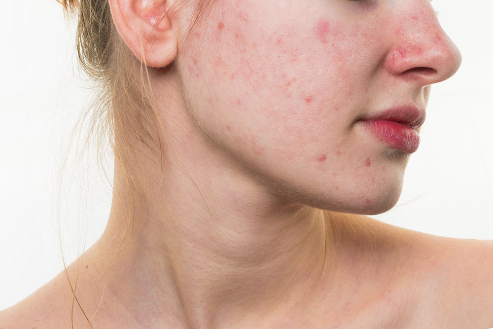  Dermaphen Acne scars